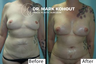 Abdominoplasty-and-Breast-lift-Mastopexy-by-Dr-Kohout 1010