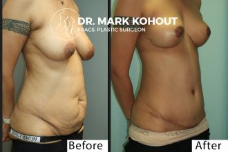 Abdominoplasty-and-Breast-lift-Mastopexy-by-Dr-Kohout 1011