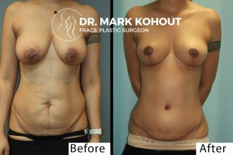 Abdominoplasty-and-Breast-lift-Mastopexy-by-Dr-Kohout 1011