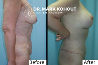Abdominoplasty-Breast-lift-Mastopexy-and-implants-by-DrKohout 1012