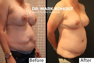 Abdominoplasty-implant-removal-and-Breast-lift-Mastopexy-by-Dr-Kohout 1013