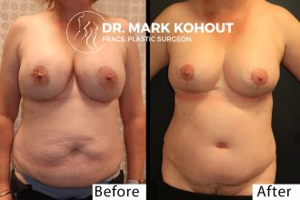Abdominoplasty-implant-removal-and-Breast-lift-Mastopexy-by-Dr-Kohout 1013