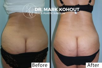 Mini-Tummy-tuck-lower-Abdominoplasty-and-Liposuction by Dr Kohout 1015