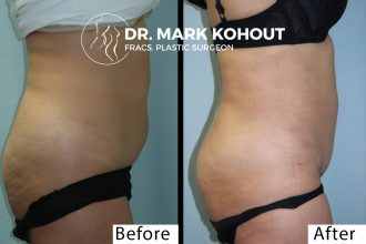 Mini-Tummy-tuck-lower-Abdominoplasty-and-Liposuction by Dr Kohout 1015