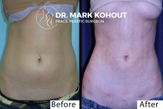 Abdominal-Liposuction by Dr Kohout 1039