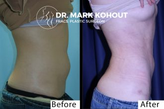 Abdominal-Liposuction by Dr Kohout 1039