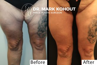 Thigh-lift-thigh-reduction-by-Dr-Kohout 1042