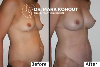 Abdominoplasty-Tummy-tuck-Breast-lift-Mastopexy-by-Dr-Kohout 1045