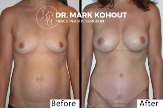 Abdominoplasty-Tummy-tuck-Breast-lift-Mastopexy-by-Dr-Kohout 1045