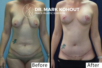 Abdominoplasty-Tummy-tuck-Breast-lift-Mastopexy-with-implant-Mastopexy-augmentation-by-Dr-Kohout 1058