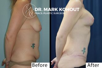Abdominoplasty-Tummy-tuck-Breast-lift-Mastopexy-with-implant-Mastopexy-augmentation-by-Dr-Kohout 1058