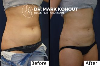 Abdominal-Liposuction by Dr Kohout 1077