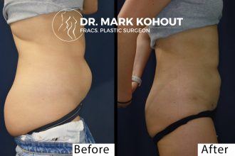 Abdominal-Liposuction by Dr Kohout 1077