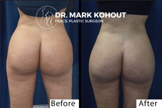 Buttock-Liposuction-and-BBL by Dr Kohout 1281