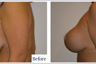 Breast Lift Before and After 16 - Dr Mark Kohout