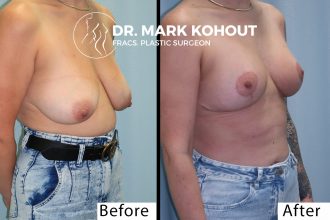 Breast-lift-Mastopexy-by-Dr-Kohout 2001