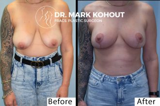 Breast-lift-Mastopexy-by-Dr-Kohout 2001