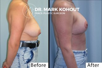 Breast-lift-Mastopexy-by-Dr-Kohout 2001