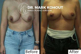 Breast-lift-Mastopexy-by-Dr-Kohout 2002
