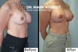 Breast-lift-Mastopexy-and-implant-exchange-by-Dr-Kohout 2003