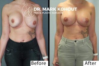 Breast-lift-Mastopexy-and-implant-exchange-by-Dr-Kohout 2003