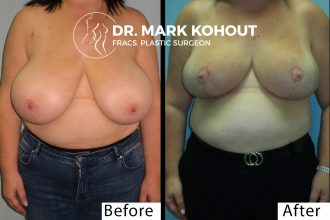 2004---Breast-Reduction-by-Dr-Kohout---front