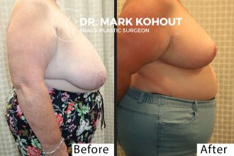 Breast-Reduction-by-Dr-Kohout 2005