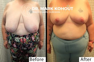 Breast-Reduction-by-Dr-Kohout 2005