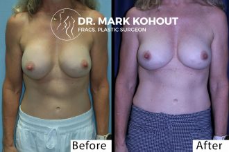 Breast-implant-revision-_-implant-exhange-by-Dr-Kohout 2037