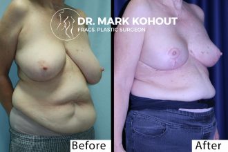 Breast-reduction-by-Dr-Kohout 2038
