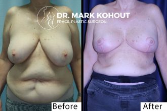 Breast-reduction-by-Dr-Kohout 2038