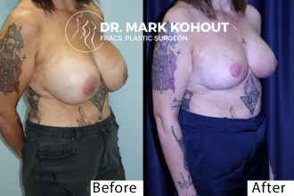 Breast-revision-correction-of-waterfall-deformity-implant-exchange-and-Breast-lift-Mastopexy-by-Dr-Kohout 2040