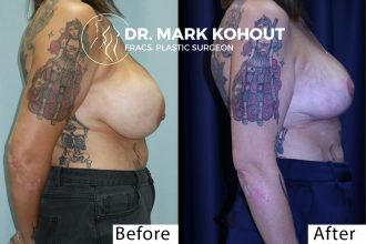 Breast-revision-correction-of-waterfall-deformity-implant-exchange-and-Breast-lift-Mastopexy-by-Dr-Kohout 2040