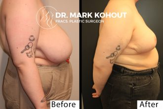 Breast-lift-Mastopexy-by-Dr-Kohout 2043