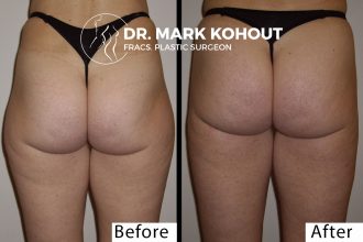 Liposuction-of-outer-thighs-Liposuction-saddlebags by Dr Kohout 2049