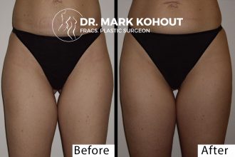 Liposuction-of-outer-thighs-Liposuction-saddlebags by Dr Kohout 2049