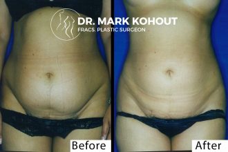 Liposuction-of-outer-thighs-Liposuction-saddlebags by Dr Kohout 2049