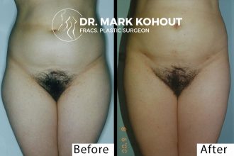 Liposuction-of-abdomen-and-outer-thighs by Dr Kohout 2050