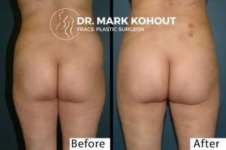 Liposuction-of-flanks-by Dr Kohout 2051