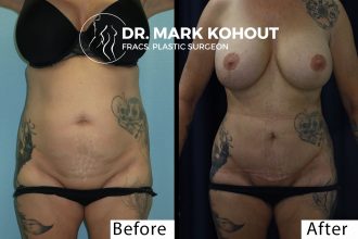 Lower-Abdominoplasty-mini-Tummy-tuck-and-Liposuction-by Dr-Kohout 2052