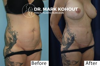 Lower-Abdominoplasty-mini-Tummy-tuck-and-Liposuction-by Dr-Kohout 2052