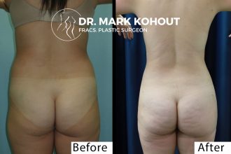 Liposuction-to-back-and-buttocks-fat-graft-to-buttocks-BBL-by Dr-Kohout 2053