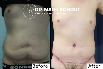 Body Lift - Belt Lipectomy Before and After Photo by Dr.Kohout - 2054