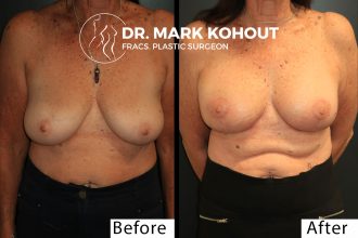 Breast-LIft-Mastopexy-and-fat-graft-by-Dr-Kohout 2055