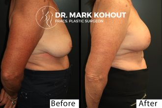 Breast-LIft-Mastopexy-and-fat-graft-by-Dr-Kohout 2055