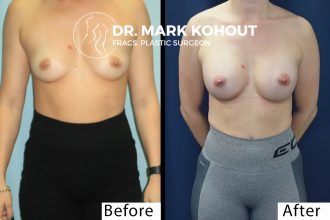 Breast-augmentation-300cc-teardrop-by-Dr-Kohout 2057