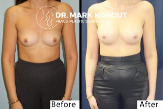 Breast-Augmentation-250-cc-round-by-Dr-Kohout 2060