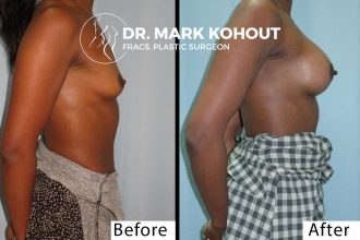 Breast-Augmentation-425cc-round-implants by-Dr-Kohout 2061