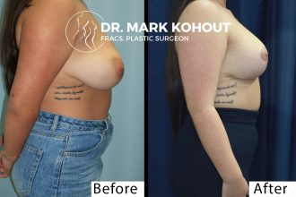 Breast-LIFT-AND-IMPLANT-Mastopexy-AUGMENTATION-BY-Dr-Kohout 2062