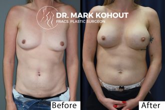 Breast-augmentation-350cc-round-by-Dr-Kohout 2064